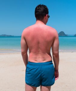 image showing a man with sunburn